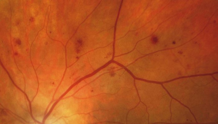 microaneurysms and hemorrhages in advanced Diabetic Retinopathy
