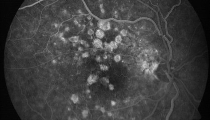 Ayurveda treatment for Age-related Macular Degeneration Ayurveda treatment for Age-related Macular Degeneration