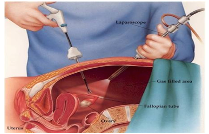laparoscopy for infertility diagnosis