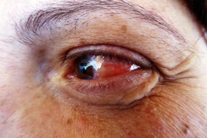 This Summer, treat Conjunctivitis with Ayurveda